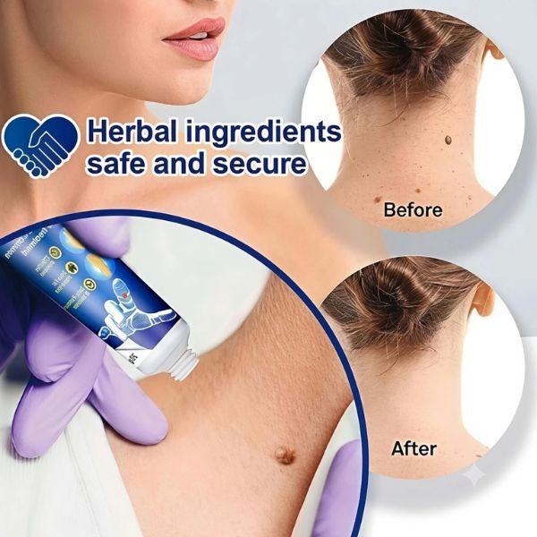 Wart Remover Gel (Buy 1 Get 1 Free)