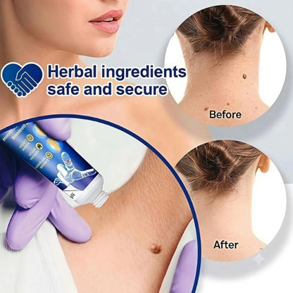 Wart Remover Gel (Buy 1 Get 1 Free)